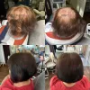 TCR Laser Hair Treatment + - professzionális lézeres hajterápia készülék ampullával 1db